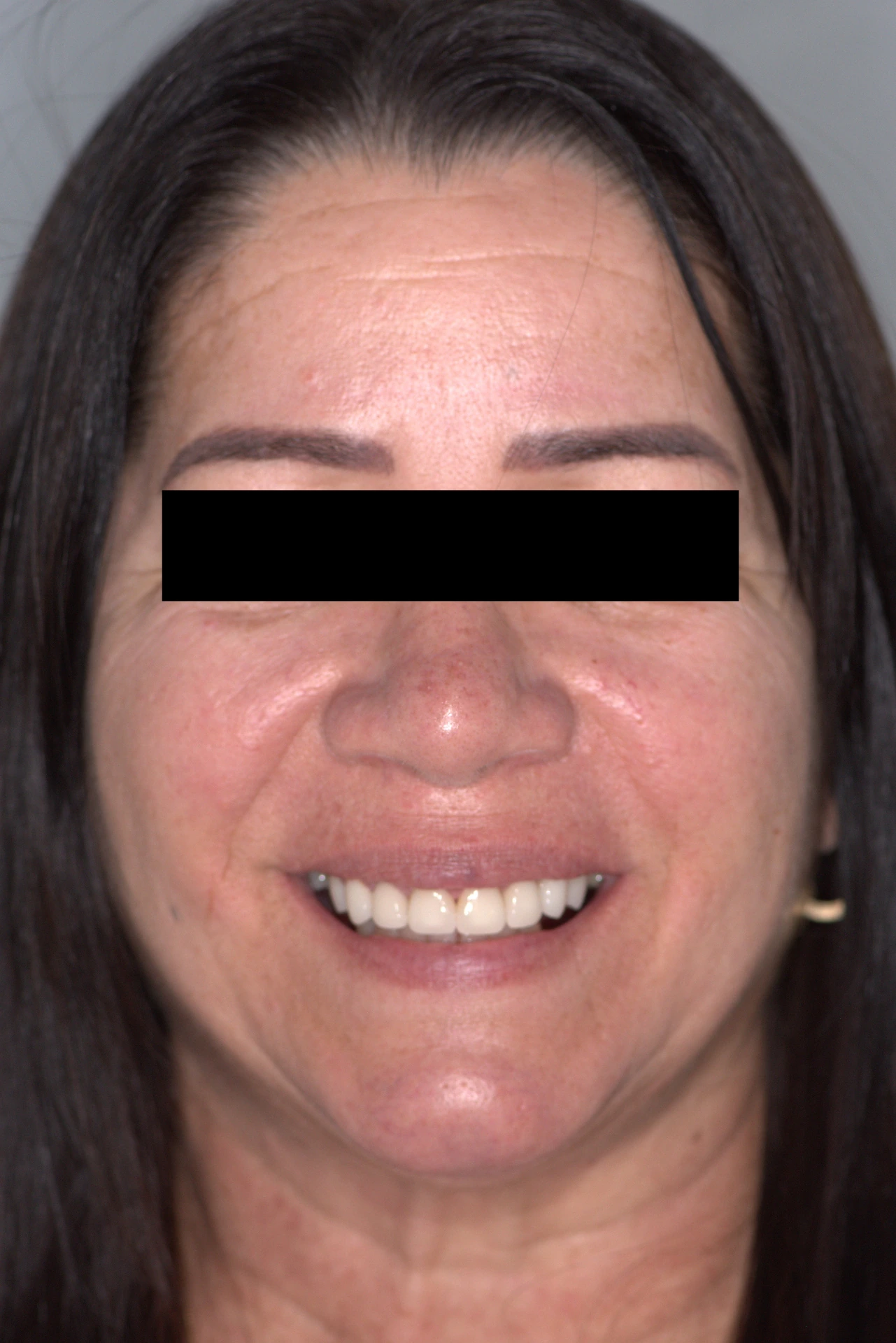 Full Mouth Reconstruction (FMR) full face after