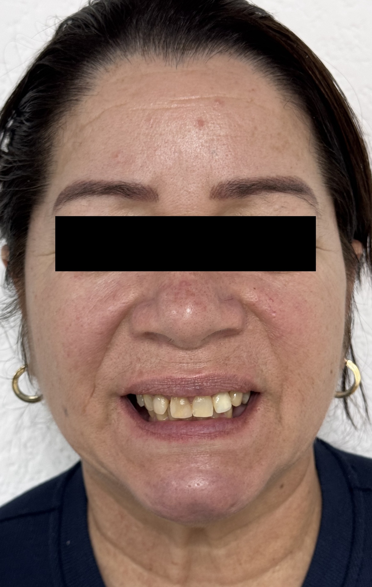 Full Mouth Reconstruction (FMR) full face before
