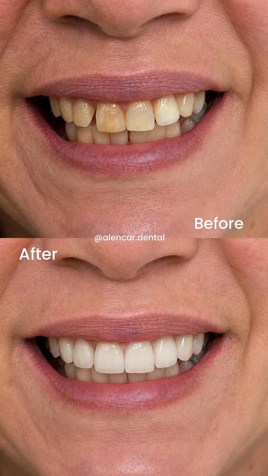 Before and after full upper arch crowns completed by Dr. Simone Alencar