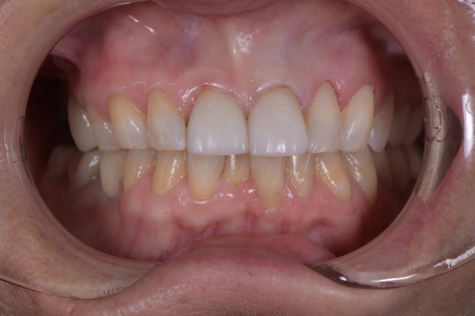 Before treatment: two front teeth appear bulky, matte, and whiter than the surrounding teeth