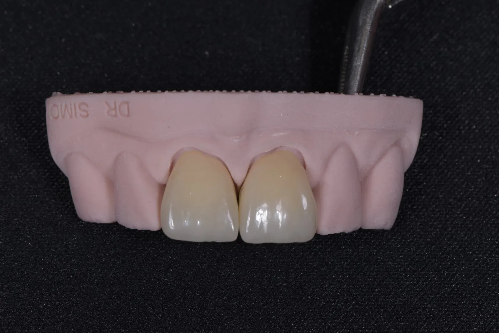 The two front crowns shown on a dental model
