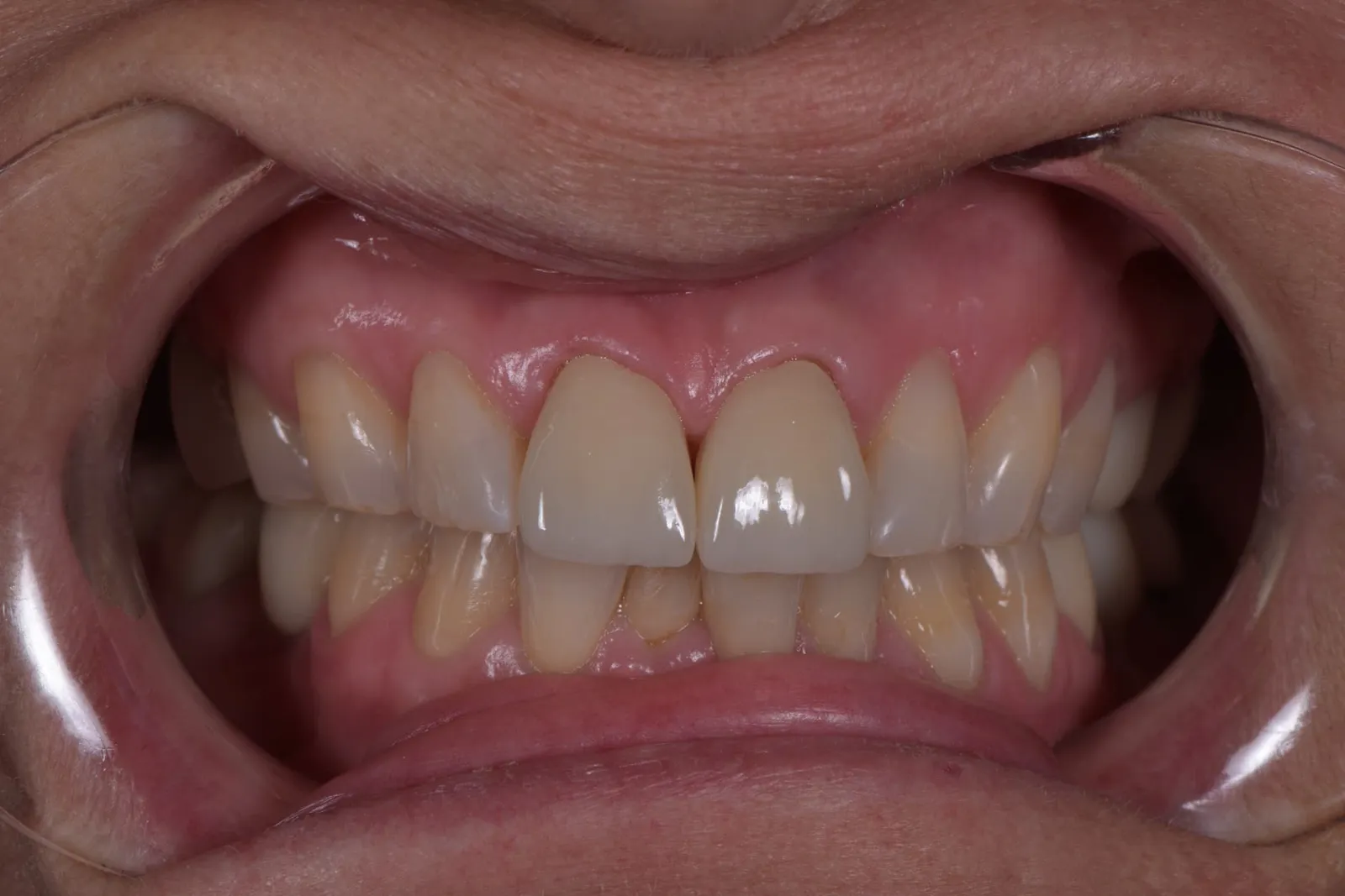 After restorative crown treatment: two front teeth with a more natural shape and color matching the surrounding teeth