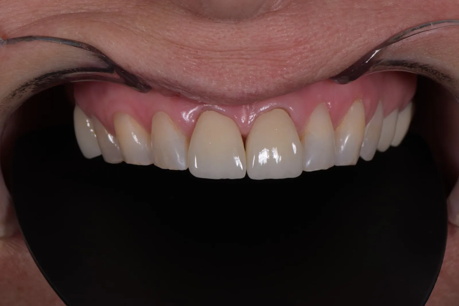 After treatment: close-up of the restored upper front teeth