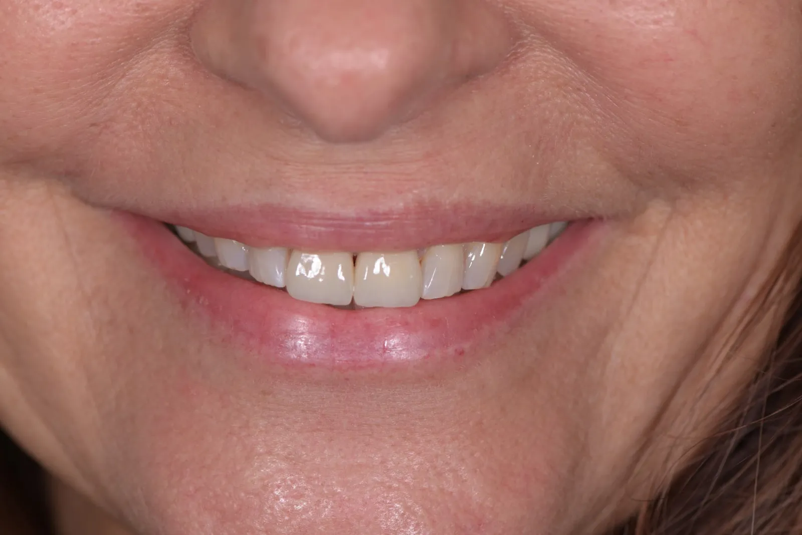 Close-up of a patient smiling naturally after restorative crown treatment on her two front teeth at Alencar Dental