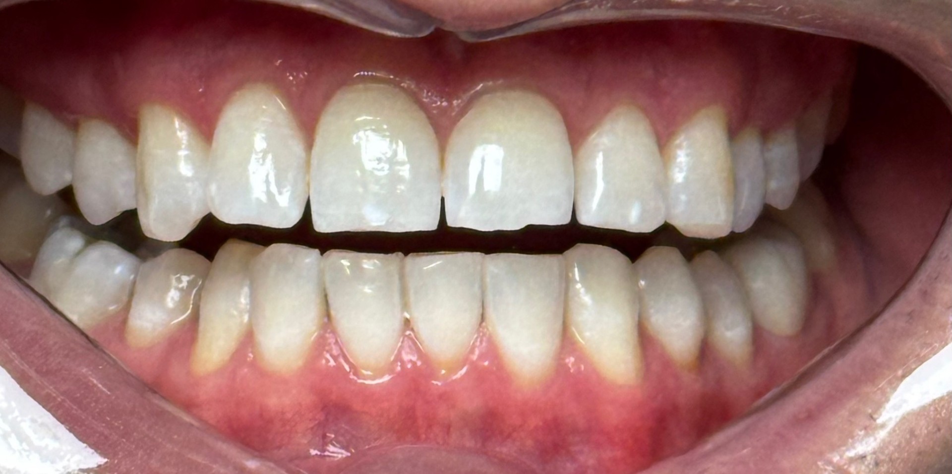 Professional Teeth Whitening after
