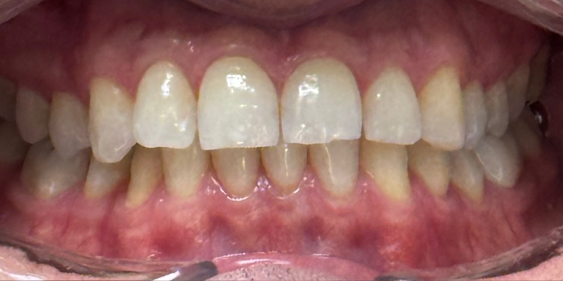 Professional Teeth Whitening before